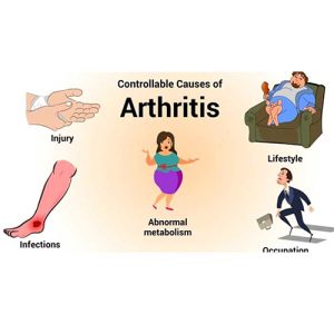 Arthritis by UPH-3